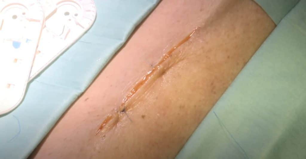 Comment suturer la peau humaine